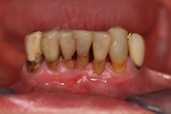 Impianti dentali