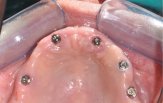Chirurgia Implantare Guidata