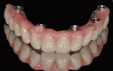 Chirurgia Implantare Guidata