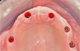Chirurgia Implantare Guidata