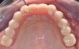 Chirurgia Implantare Guidata